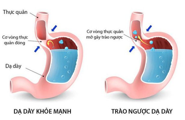 khám trào ngược dạ dày ở cai lậy