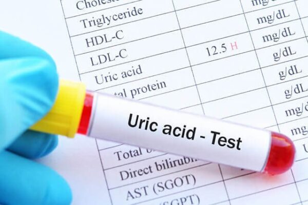 xét nghiệm acid uric bệnh gout