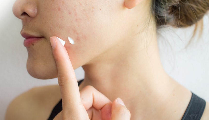 điều trị mụn tại cai lậy