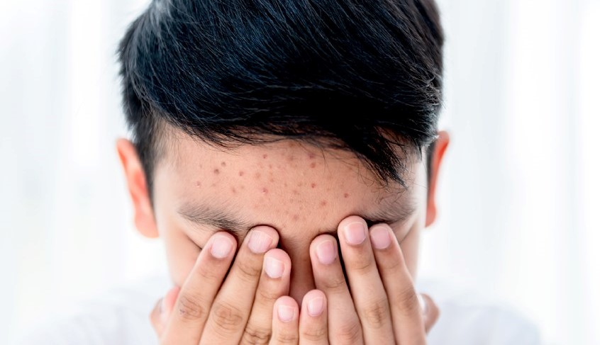 điều trị mụn tại cai lậy